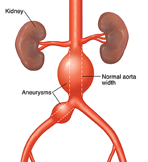 Front view of abdominal aorta with aneurysms. Dotted line shows normal width of aorta.