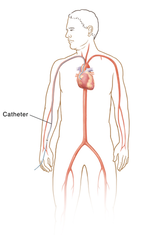 Outline of male figure showing transradial cardiac catheterization.