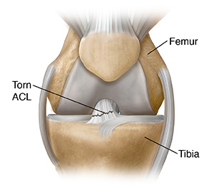 Front view of knee joint showing tear in anterior cruciate ligament.