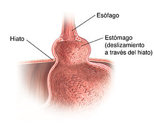 Corte transversal del estómago, del esófago y del diafragma donde se observa una hernia de hiato por deslizamiento.