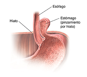 Corte transversal del estómago, del esófago y del diafragma donde se observa una hernia paraesofágica.