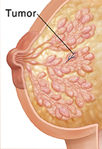 Corte transversal de una mama donde puede verse cáncer de mama no invasivo.