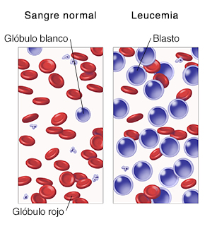 Vista microscópica de células sanguíneas en que se compara la sangre normal con la leucemia.