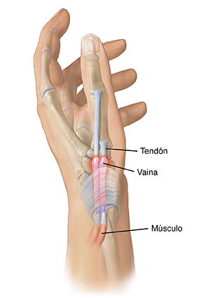 Vista lateral de la mano, donde pueden verse los tendones inflamados en la base del pulgar.