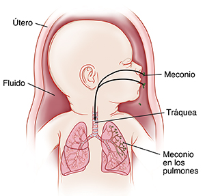 Bebé en el útero (vientre) con la cabeza hacia un lado y mostrando la tráquea y los pulmones. Presencia de meconio en el líquido del útero. Las flechas muestran el paso del meconio por la nariz y boca hasta los pulmones.