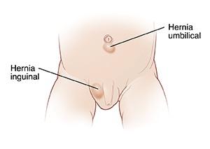 La parte inferior del abdomen de un bebé muestra un bulto en el escroto donde hay una hernia inguinal, y un bulto debajo del ombligo donde hay una hernia umbilical.