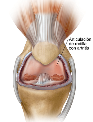 Articulación de rodilla con artritis.