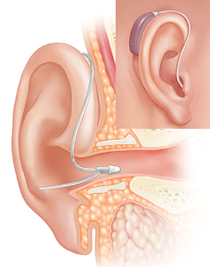 Cross section of ear showing outer, inner, and middle ear structures with receiver-in-ear hearing aid in place with inset of external view.