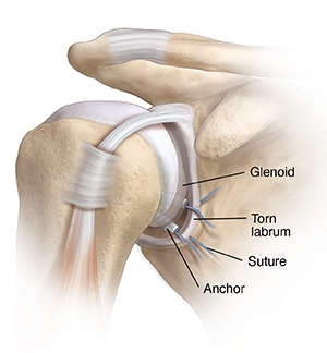 Front view of shoulder joint showing tears at top and bottom of labrum. Anchors are being placed to repair tears.