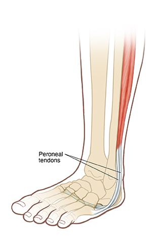 What Is Tendonitis of the Foot?