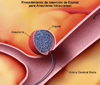 Ilustración de un procedimiento con espiral para un aneurisma intracraneal
