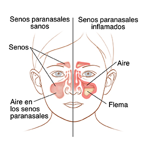 Vista frontal de la cara de un niño donde puede verse la anatomía normal de un seno paranasal en un lado y senos paranasales inflamados en el otro.