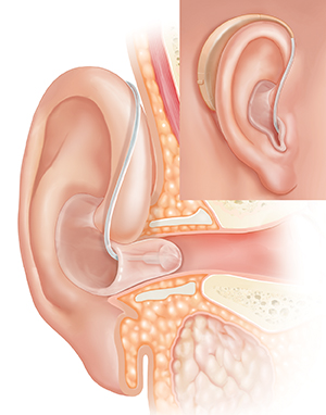 Corte transversal del oído donde se observa el oído externo con un audífono colocado detrás de la oreja y un recuadro en el que se muestra la vista externa.