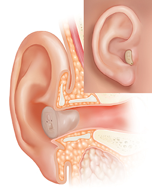 Corte transversal del oído donde se observa el oído externo con un audífono colocado en el conducto auditivo externo y un recuadro en el que se muestra la vista externa.