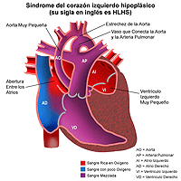 Anatomía de un corazón con síndrome del corazón izquierdo hipoplástico