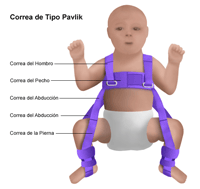 Ilustración de un bebé con un arnés de Pavlik