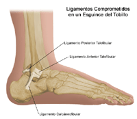 Ilustración que muestra los tres ligamentos involucrados en los esguinces/distensiones musculares de tobillo