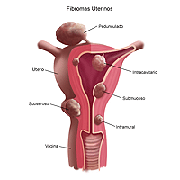 Ilustración de fibromas uterinos