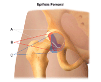 Ilustración del deslizamiento de la cabeza femoral