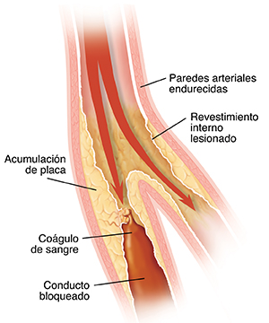Corte transversal de una arteria enferma que muestra la circulación interrumpida a la altura del coágulo y placa.