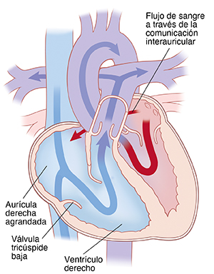Vista de las cuatro cavidades del corazón, donde se observa una anomalía de Ebstein con la aurícula derecha agrandada, la válvula tricúspide baja y la comunicación interauricular. Las flechas indican que la sangre fluye a través del corazón.