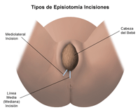 Ilustración del procedimiento de episiotomía