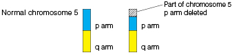 Structural Abnormalities- Deletions (cri-du-chat Syndrome) And 